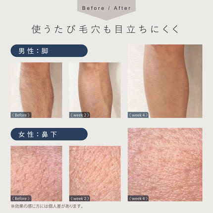 茨城県つくばみらい市のふるさと納税 LINKA フレアタッチ プロ リンカ 脱毛器 脱毛 光美容 エステ 美顔器 美容機器 美容 美肌 ボディケア VIO 顔 脇 ワキ ヒゲ 家電 美容器 [EV34-NT]